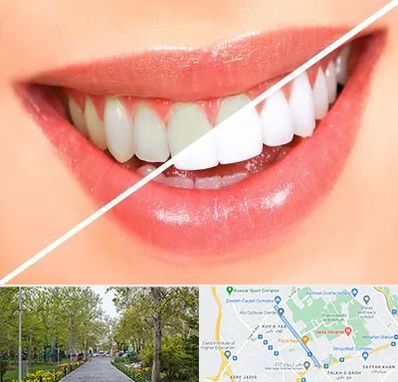 بلیچینگ دندان در قدوسی غربی شیراز