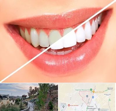 بلیچینگ دندان در باغستان کرج