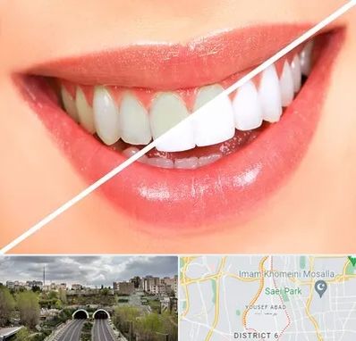 بلیچینگ دندان در یوسف آباد 