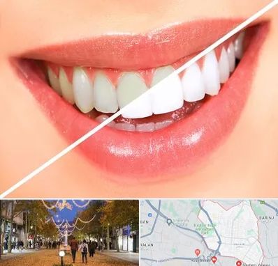 بلیچینگ دندان در ولیعصر ارومیه