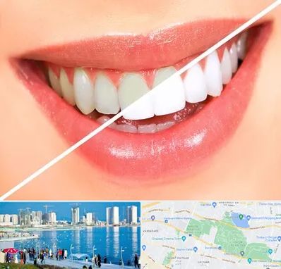 بلیچینگ دندان در چیتگر 