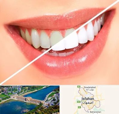 بلیچینگ دندان در اصفهان
