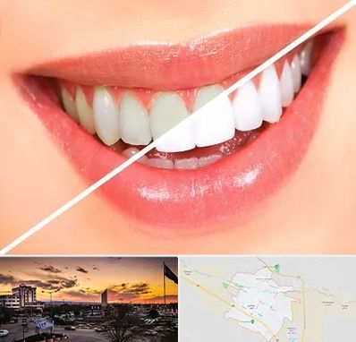 بلیچینگ دندان در قوچان