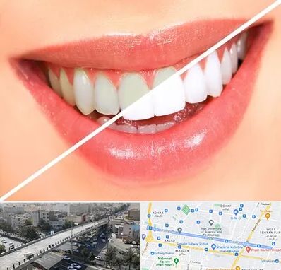 بلیچینگ دندان در فرجام