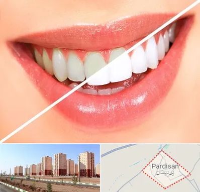 بلیچینگ دندان در پردیسان قم