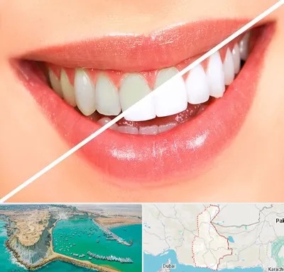 بلیچینگ دندان در سیستان و بلوچستان