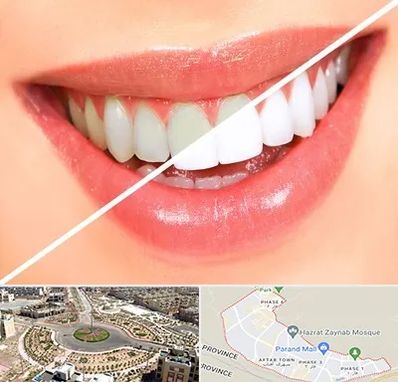 بلیچینگ دندان در پرند