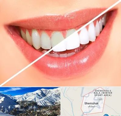 بلیچینگ دندان در شمشک