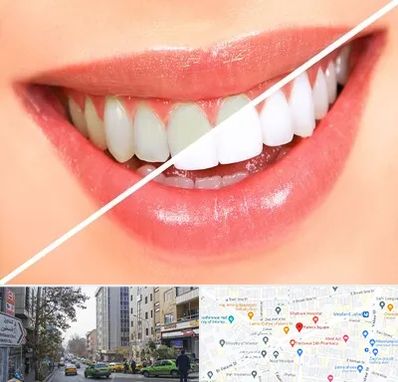 بلیچینگ دندان در فاطمی