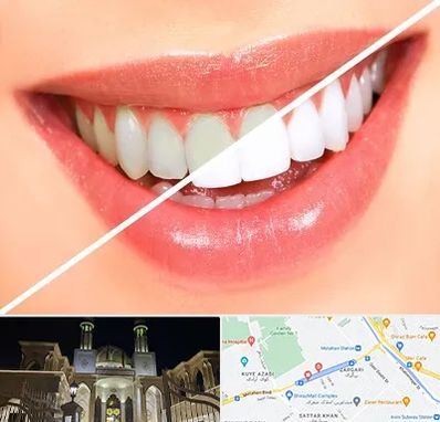 بلیچینگ دندان در زرگری شیراز