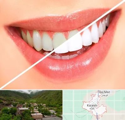 بلیچینگ دندان در کلاله