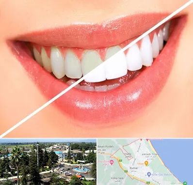 بلیچینگ دندان در رودسر