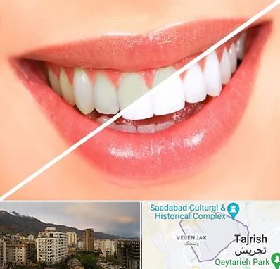 بلیچینگ دندان در زعفرانیه 