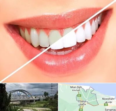 بلیچینگ دندان در چالوس