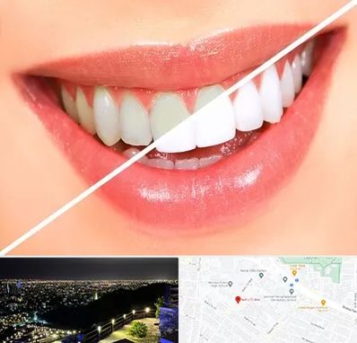 بلیچینگ دندان در هفت تیر مشهد