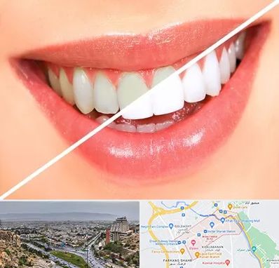 بلیچینگ دندان در معالی آباد شیراز