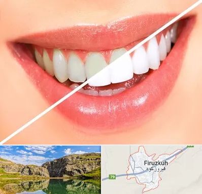 بلیچینگ دندان در فیروزکوه