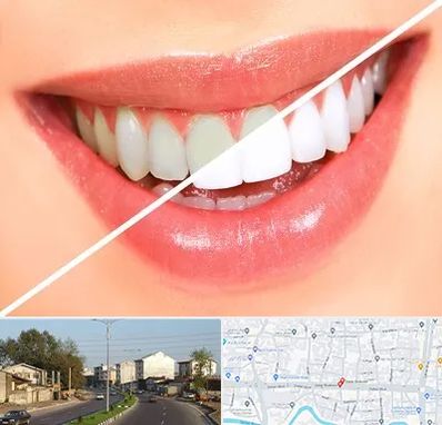 بلیچینگ دندان در ضیابری رشت