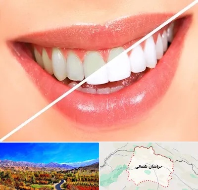 بلیچینگ دندان در خراسان شمالی