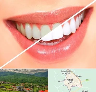 بلیچینگ دندان در آمل