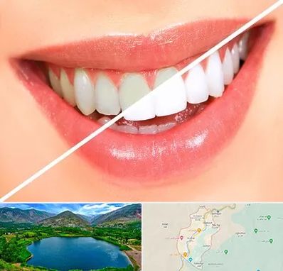 بلیچینگ دندان در رودبار