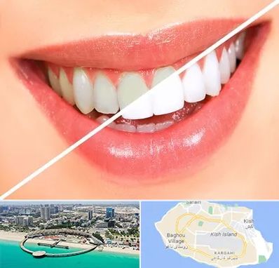 بلیچینگ دندان در کیش