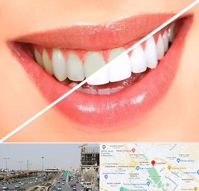 بلیچینگ دندان در بلوار توس مشهد