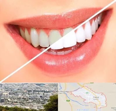 بلیچینگ دندان در یاسوج