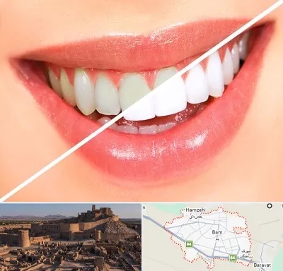 بلیچینگ دندان در بم