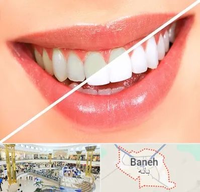 بلیچینگ دندان در بانه