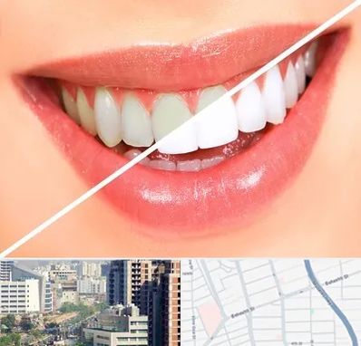 بلیچینگ دندان در خیابان بهشتی