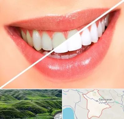 بلیچینگ دندان در گچساران