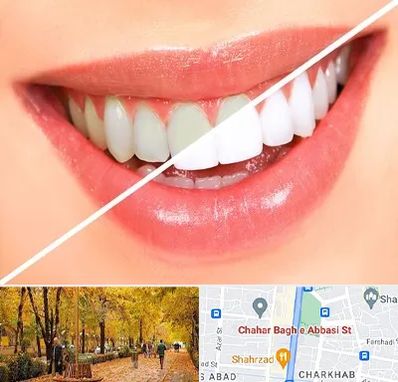 بلیچینگ دندان در چهارباغ اصفهان