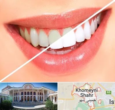 بلیچینگ دندان در خمینی شهر