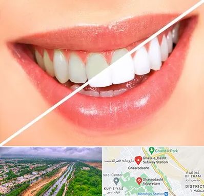 بلیچینگ دندان در قصرالدشت شیراز
