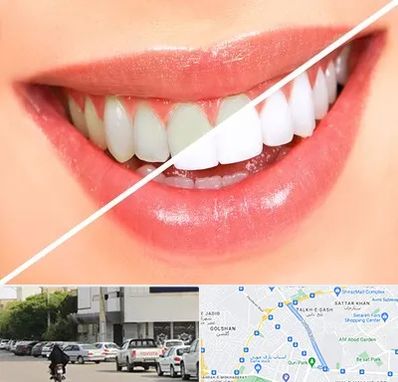 بلیچینگ دندان در قدوسی شرقی شیراز