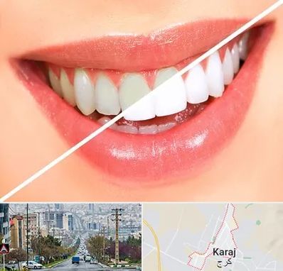 بلیچینگ دندان در گوهردشت کرج 