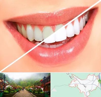 بلیچینگ دندان در فومن