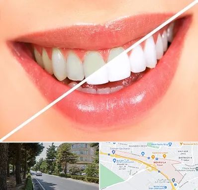 بلیچینگ دندان در مهرویلا کرج