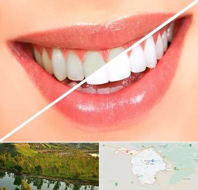 بلیچینگ دندان در بهبهان