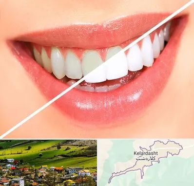 بلیچینگ دندان در کلاردشت
