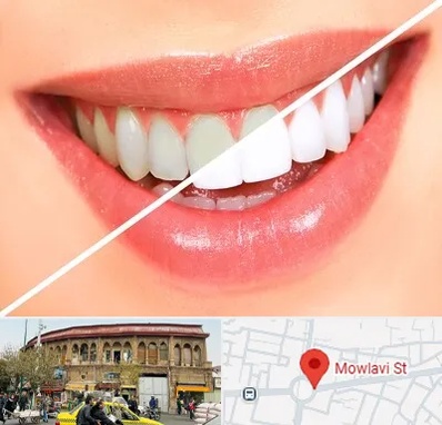 بلیچینگ دندان در مولوی