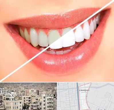 بلیچینگ دندان در اسکندری