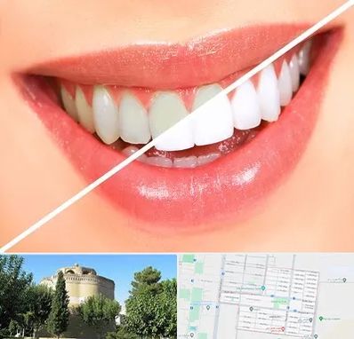 بلیچینگ دندان در مرداویج اصفهان