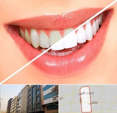 بلیچینگ دندان در نجات اللهی