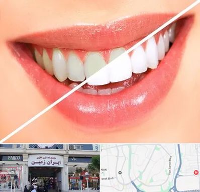 بلیچینگ دندان در ایران زمین