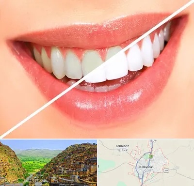 بلیچینگ دندان در کامیاران
