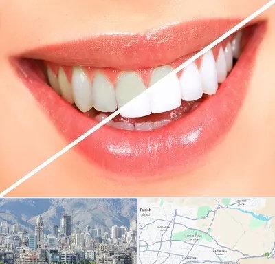 بلیچینگ دندان در شمال شرق تهران