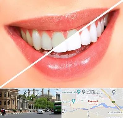 بلیچینگ دندان در پاکدشت
