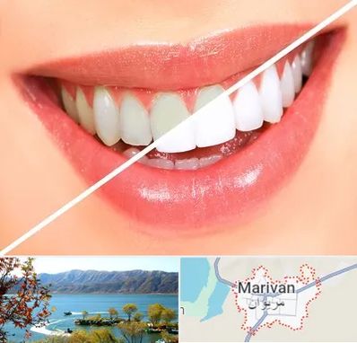 بلیچینگ دندان در مریوان